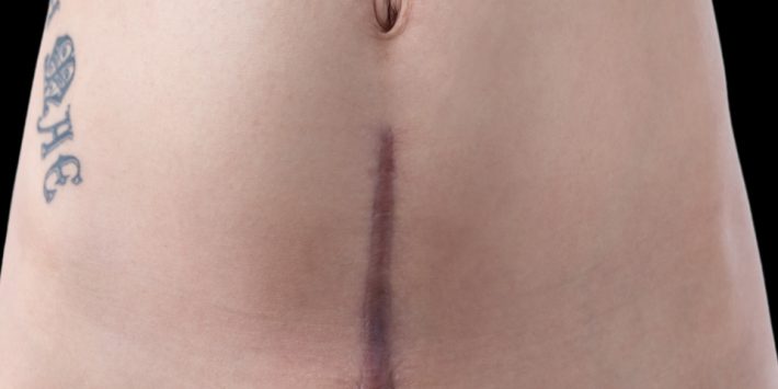 Tattooing Scars