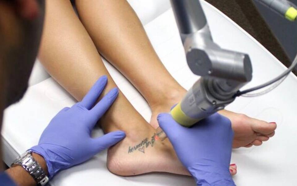 8 Things to Know Before Getting Laser Tattoo Removal 